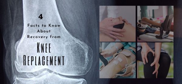 4 Facts to Know About Recovery from Knee Replacement